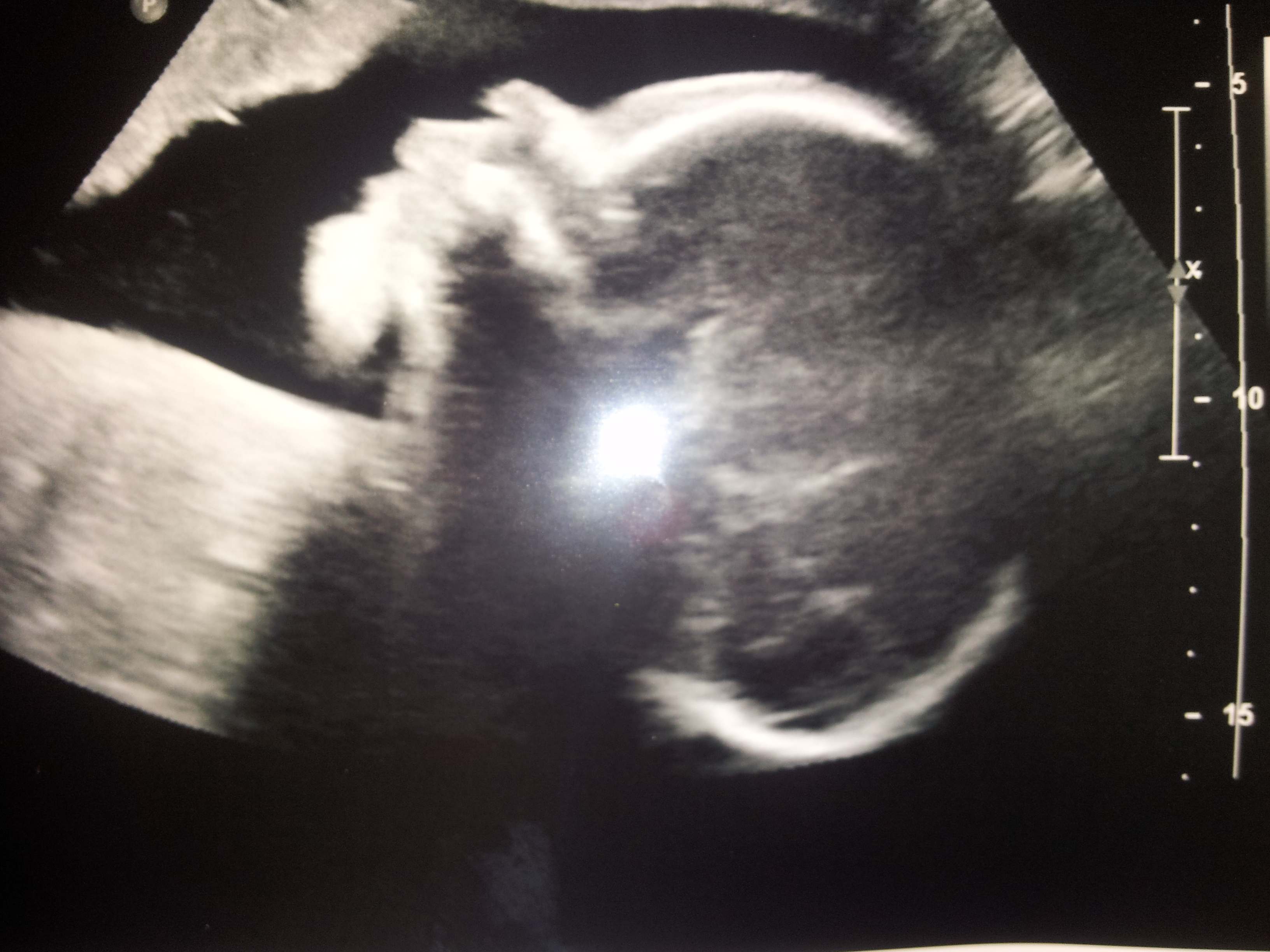 photo of 29 week old fetus
